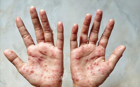 WHO kêu gọi công chúng hỗ trợ đổi tên bệnh đậu mùa khỉ