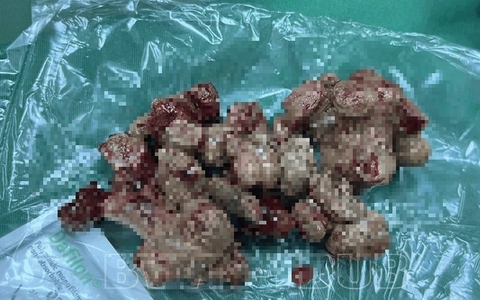 Cụ bà 81 tuổi phải cắt bỏ thận do sỏi san hô