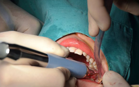 Áp xe vùng mặt - Hậu quả nặng nề khi chủ quan với biến chứng mọc răng khôn