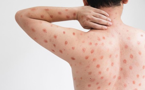Xuất hiện dịch "cúm cà chua" rất dễ lây lan ở trẻ em tại Ấn Độ