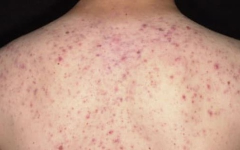 Suýt tử vong sau 30 phút lăn kim trị mụn ở lưng