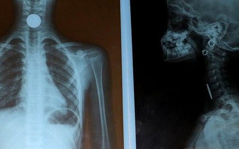 2 việc cần làm ngay khi trẻ bị hóc dị vật
