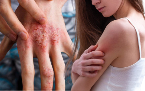 Hơn 5 triệu người Việt mắc tiểu đường: 5 dấu hiệu chứng tỏ đường huyết đang tăng