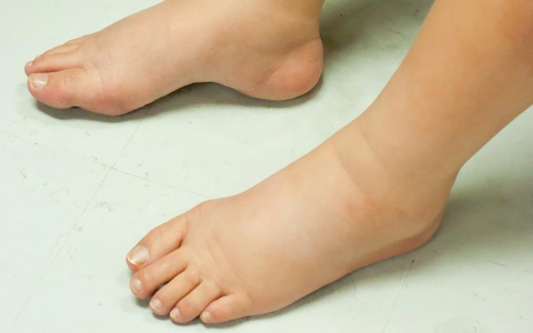 10 dấu hiệu sớm của bệnh suy thận