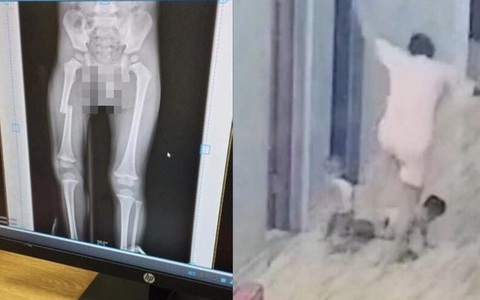 Hoàn cảnh gia đình bé trai bị mẹ đạp gãy xương đùi