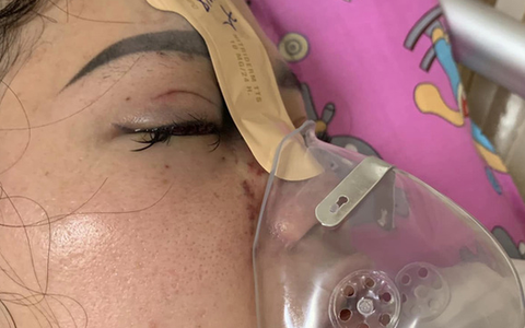 Mù mắt vì tiêm filler nâng mũi tại spa