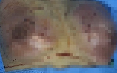 Tiêm filler nâng ngực, người phụ nữ bị hoại tử núi đôi, sắp vỡ