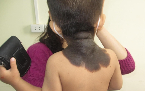 2 loại thực phẩm mẹ bầu nên tránh để con không bị chàm xanh, chàm đỏ