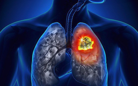 Phát hiện khối u ác tính ở phổi sau thời gian dài bị ho