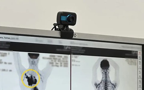 Chuyên gia tập gym cứ tưởng đau do tập luyện, hóa ra là khối ung thư