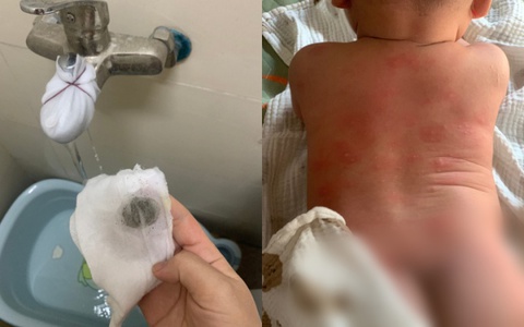 Sở Xây dựng Hà Nội lên tiếng vụ hàng trăm cư dân nổi mẩn ngứa, bong tróc da khi dùng nước sinh hoạt