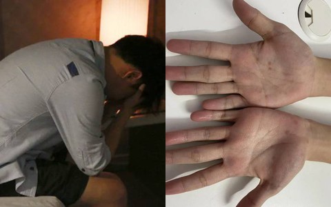 Sợ bị đậu mùa khỉ, nam thanh niên 26 tuổi đi khám mới phát hiện bệnh không ngờ