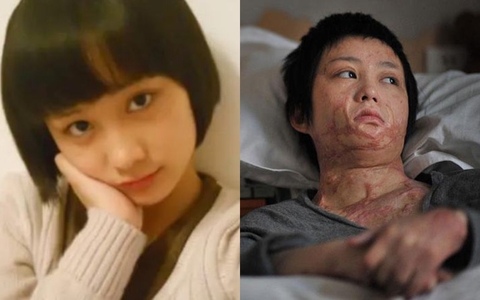 Khúc mắc tình cảm với thiếu gia nhà giàu, cô gái 16 tuổi bị "hủy dung": Hành trình sống tiếp khó như lên trời