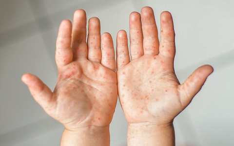 Trẻ sơ sinh và trẻ nhỏ mắc chân tay miệng cần kiêng khem gì, chăm sóc như thế nào để nhanh khỏi bệnh?