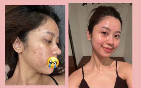 Hàn Hằng từng bị mụn ồ ạt quanh mặt: Giờ đây sở hữu làn da căng bóng, láng mịn nhờ chọn đúng sản phẩm skincare