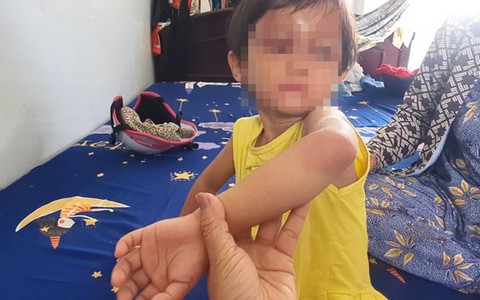 Khởi tố, bắt giam cha nuôi bạo hành cháu bé 3 tuổi ở Cà Mau
