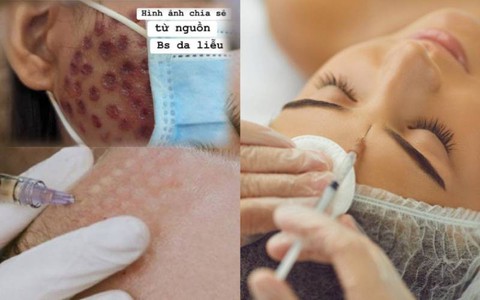 Tưởng tiêm meso căng bóng da, có người đau đớn nhận lại khuôn mặt "rỗ như tổ ong", ai nhìn cũng phải xót xa