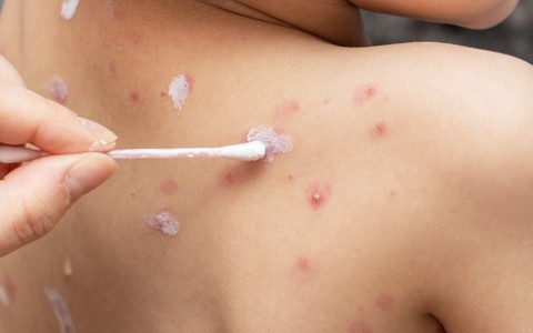 Thời tiết thay đổi, cẩn trọng bệnh sởi, thủy đậu ở trẻ nhỏ