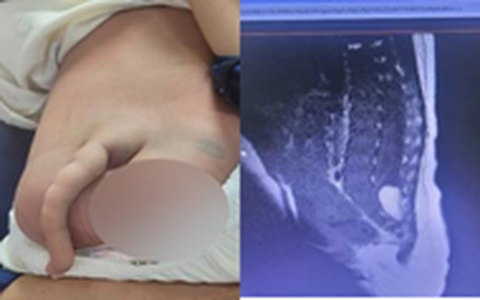 Phẫu thuật thành công cho bé trai 4 tháng tuổi có "đuôi" dài 14cm