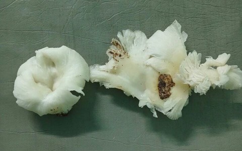 Ăn nấm lạ, 3 người trong một gia đình ở Quảng Nam co giật, trụy tim mạch