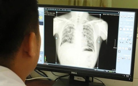Vụ 6 công nhân tử vong do bụi phổi ở Nghệ An: Thêm 57 người mắc bệnh