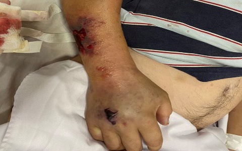 Thanh niên 26 tuổi bị gout mãn tính gây sốc nhiễm khuẩn nặng, may mắn được cứu sống