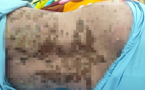 Suýt mất mạng vì dùng thuốc nam không rõ nguồn gốc chữa đau khớp