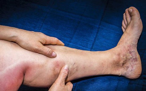 Căn bệnh có thể 'mất mạng', dấu hiệu cảnh báo chỉ từ sưng đau ở chân