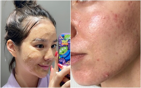 Cách làm mặt nạ trị mụn trứng cá siêu dễ tại nhà