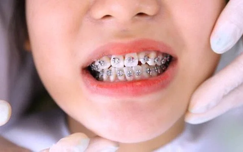 Bác sĩ tiết lộ sự thật về lời đồn 'cứ niềng răng là bị hóp má' và nguyên tắc cần nhớ để khắc phục
