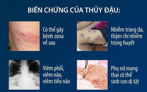 Bệnh thủy đậu bùng phát ở Hà Nội: Chuyên gia khuyến cáo cách phòng bệnh