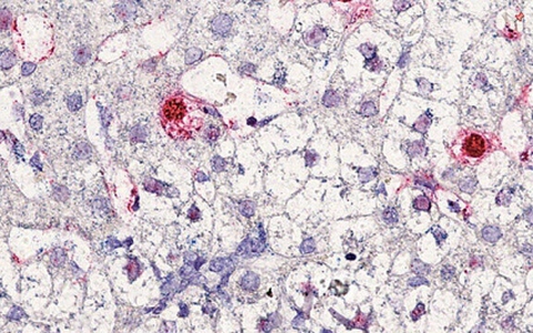 Phát hiện virus mới gây bệnh viêm gan ở người