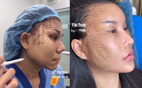Kiểu căng da "mặt rắn" đang rầm rộ trên Tiktok, sự thật phía sau được bác sĩ giải đáp