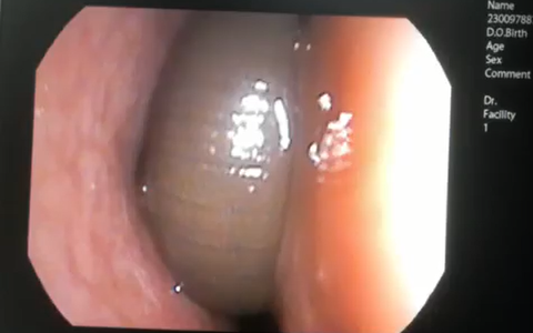 Chảy máu mũi suốt 3 tháng vì đỉa ký sinh