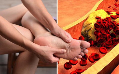 Dấu hiệu ‘kỳ lạ’ ở ngón chân cảnh báo mỡ máu đang tăng cao
