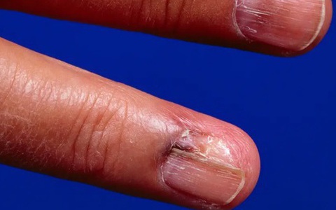 5 dấu hiệu khó nhận biết của ung thư da và lời kêu gọi của chuyên gia da liễu