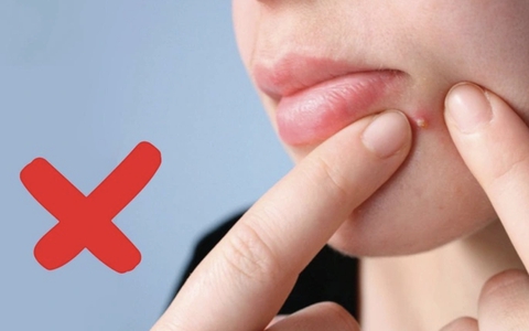 3 biến chứng đáng sợ khi nặn mụn không đúng cách