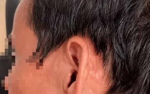 Hàng chục con giòi làm tổ trong tai người đàn ông ở Quảng Trị