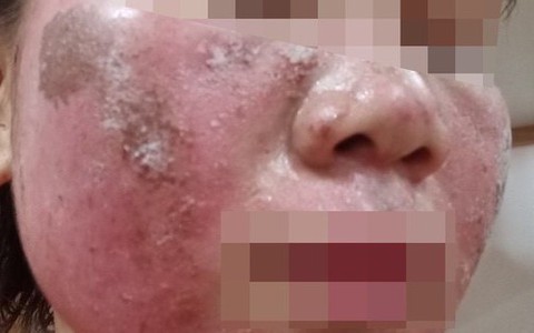 Sau hai tuần bôi kem peel da mua trên mạng, cô gái 26 tuổi hoảng hốt tìm bác sĩ