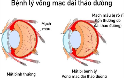 Cứ 10 ca mắc đái tháo đường có 6 ca biến chứng tại mắt: Bệnh âm thầm, đa số người bệnh không biết cho đến khi tiến triển nặng