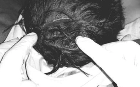 Bé 18 tháng tuổi bị chó cắn lộ xương sọ