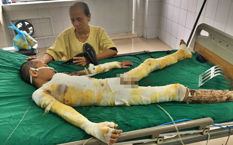 Mẹ khóc ngất cầu cứu vì con trai bị điện giật bỏng nặng không tiền cứu chữa