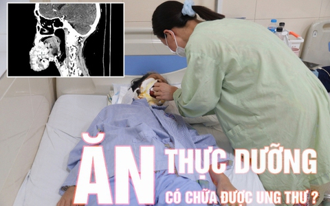 Người phụ nữ có khối u di căn từ môi xuống hàm: Bác sĩ nói về lời đồn 'ăn thực dưỡng chữa ung thư'