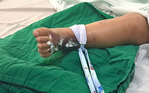 Bị rắn hổ mèo cắn, bé trai sốc nhiễm trùng, nhiễm độc toàn thân