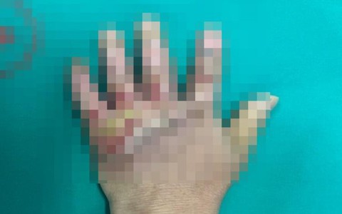 Nhiễm trùng nặng bàn tay do chữa bỏng bằng thuốc 'lạ'