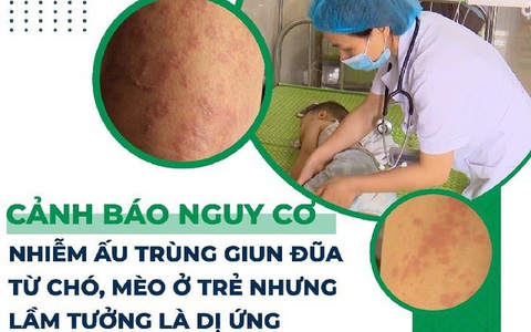 Cảnh báo nguy cơ nhiễm ấu trùng giun đũa từ chó, mèo ở trẻ