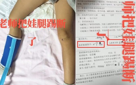 Thầy giáo đá học sinh gãy chân chỉ vì không nghỉ trưa đúng giờ
