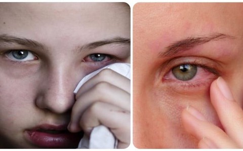 Nhìn vào mắt người đau mắt đỏ có bị lây không?