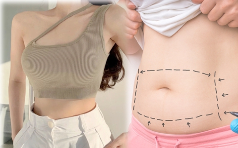Phẫu thuật tạo hình thành bụng để có eo săn chắc, rãnh bụng sâu: 5 yếu tố tác động đến kết quả cuối cùng