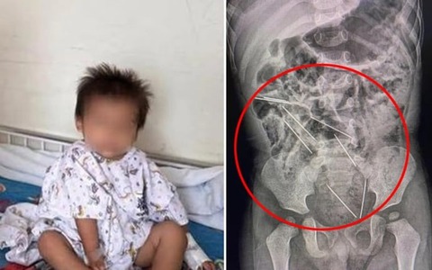 Nuốt phải 8 cây kim tiêm dành cho gia súc, cậu bé 2 tuổi may mắn được cứu